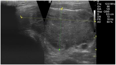 Primary Ewing Sarcoma of the Thyroid—Eight Cases in a Decade: A Case Report and Literature Review